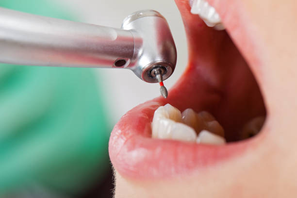 Best Emergency Root Canal Treatment in Mineral Springs, AR